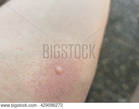 Close-up Of Skin With A Mosquito Bite And Reddened Skin