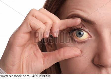 Woman Checking Her Health Condition On White Background, Closeup. Yellow Eyes As Symptom Of Problems