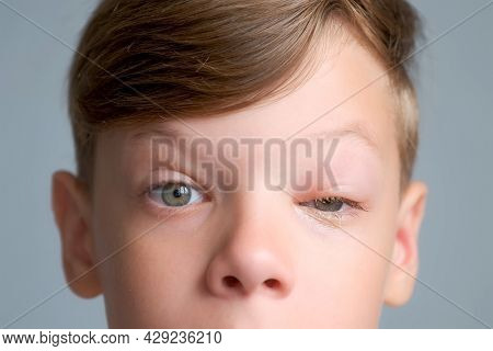 Face Of Boy With A Swollen Eye From An Insect Bite. Allergy To Insect Bites.