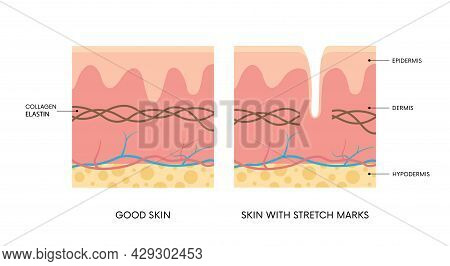 Anatomy Of Skin With And Without Stretch Marks. Collagen, Elastin, Striae. Body Positivity, Beauty, 