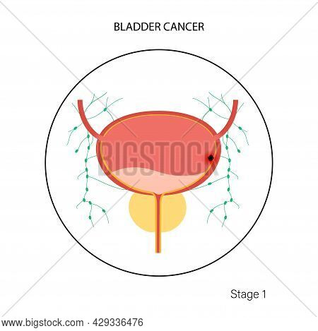 Bladder Cancer First Stage Of Tumor Spreading. Bladder, Urethra, Lymph Nodes And Prostate In Male Bo