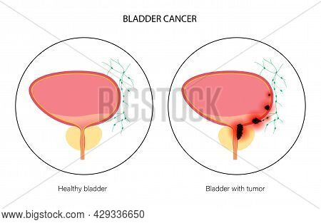 Bladder Cancer Stages Anatomical Poster. Bladder, Urethra, Lymph Nodes And Prostate In Male Body. In