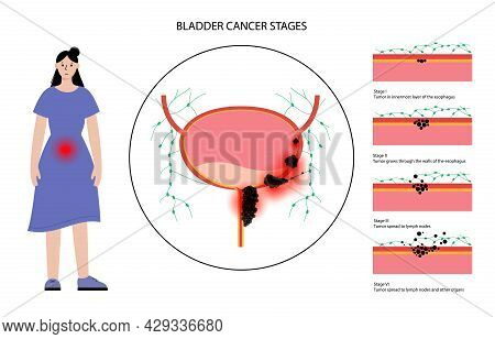 Bladder Cancer Stages Anatomical Poster. Bladder, Urethra, And Lymph Nodes In Female Body. Inflammat