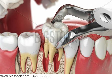 Tooth extraction by dental forceps on model of human jaw. 3d illustration