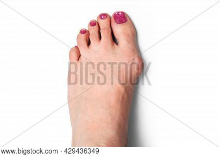 Hallux Valgus Orthopedic Medical Thumb Brace Isolated On White Background. Orthoses For Toes.