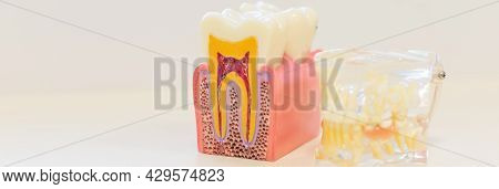 Dental Decay Model Shows Good Tooth. Plastic Model Tooth Without Caries. Inflammation Of The Nerves 