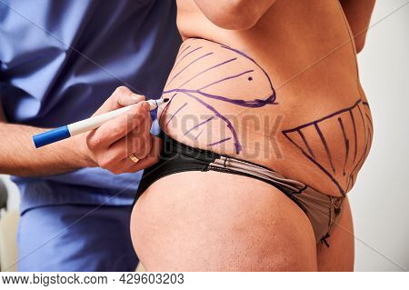 Close Up Of Doctor In Blue Medical Uniform Drawing Marks On Female Patient Skin Of Fat Woman In Unde
