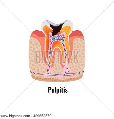 Dental Disease Flat Poster With Pulpitis Anatomy Vector Illustration
