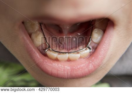 Young Boy Having A Dental Space Maintainer In His Mouth
