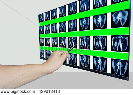 Mri Of Hip Joint. Doctor Pointed On Area Of Hip Joint, When Pathology Is Detected,tumor Or Mass Diag