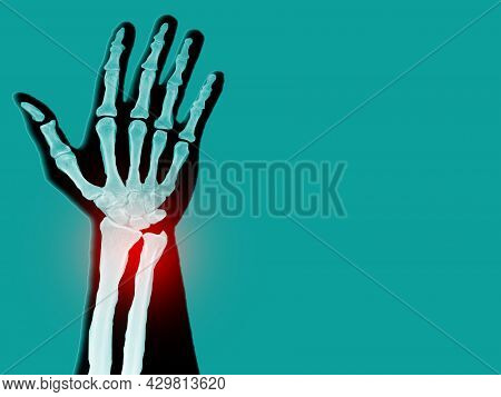 Film X-ray Wrist Simulating Photography Show Wrist Bone Broken From Falling. Highlight On Broken Sit