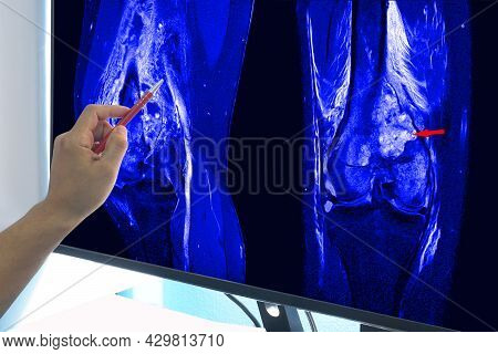 Magnetic Resonance Imaging (mri) Of Right Knee Suggestive Of Malignant Bone Tumor, Involving Epiphys