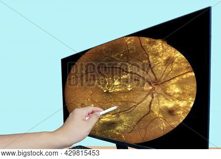 Close Up Hand Doctor Point Lcd Monitor Report  Screen Fundus Photography Of Diabetes.medical Healthc