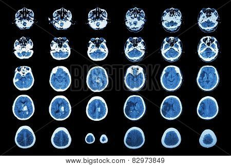 Hemorrhagic Stroke And Ischemic Stroke