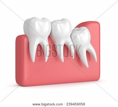 3D Render Of Teeth With Wisdom Crowding