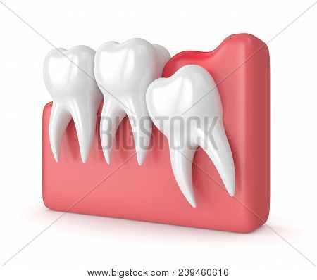 3D Render Of  Wisdom Mesial Impaction With Pericoronitis