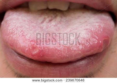 A Tongue With Ulcers Of Adult Man