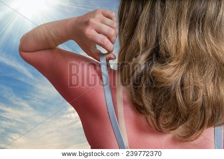 Sunburn Concept. Young Woman With Red Sunburned Skin On Her Back.