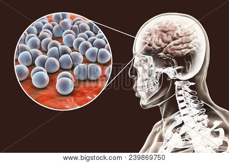 Brain Infection Caused By Streptococcus Pneumoniae Bacteria, Medical Concept, 3d Illustration
