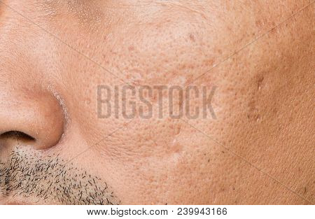 The Cheek Of Men With Facial Problems. Acne Scars,large Pores,pimple, Comedone,oily And Dull Skin.th