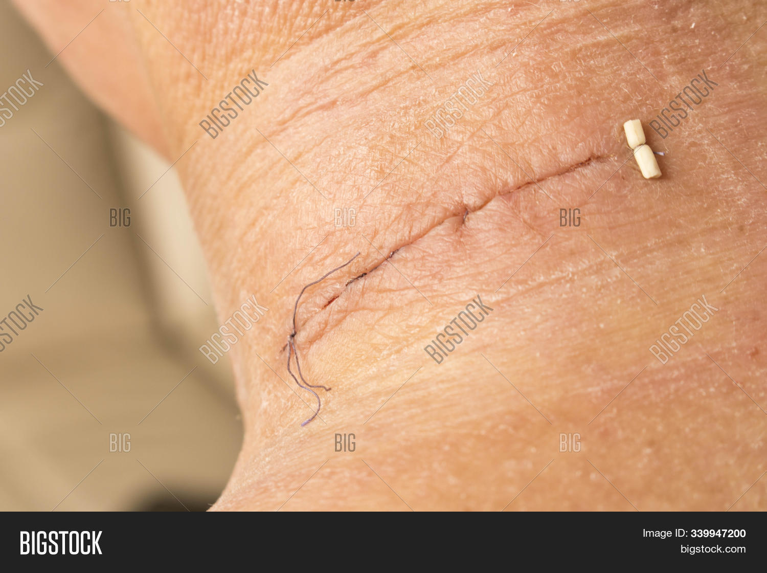 Suture After Surgery Image & Photo (Free Trial) | Bigstock