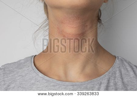 Allergic Itchy Skin On Girl Neck. Teen With Rash Dry Skin On Neck. Dermatological Problem. Girl With