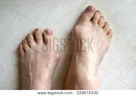 Hallux Valgus, Big Abnormal Feet Bones.  Bunion On Big Toes Of Female Feet Isolated On Light Backgro