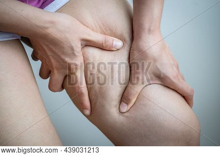 Woman With Cellulite (known As Orange-peel Skin) Problem Appears On Her Legs. Cellulite It Forms Whe