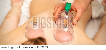 Acupuncture Woman Therapist Placing The Cup On The Back Of A Female Patient