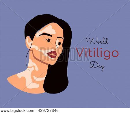 Young Asian Woman Live With Vitiligo. Different Beauty, Self Love And Skin Disease Concept. World Vi