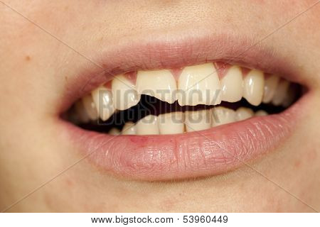 Broken Tooth