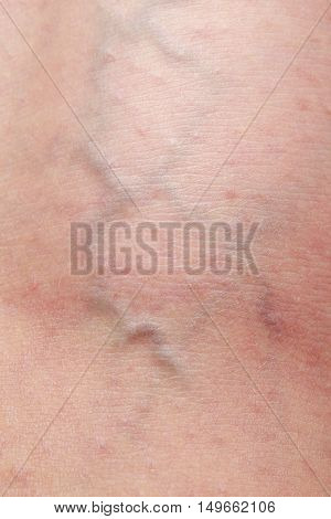 the disease varicose veins on a legs
