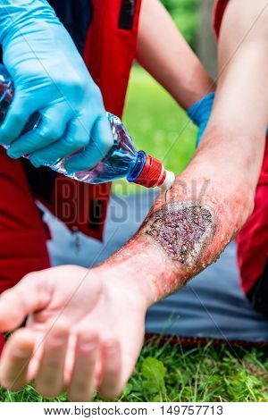 Medical Worker Treating Burns On Male's Hand