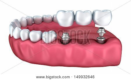3d lower teeth and dental implant isolated on white
