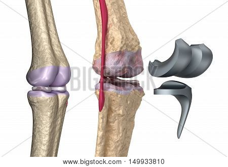 Knee and titanium hinge joint. Isolated on white