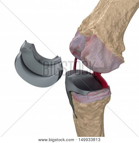 Knee and titanium hinge joint. Isolated on white