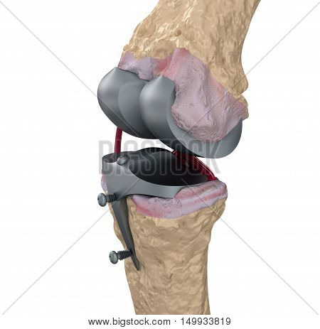 Knee and titanium hinge joint. Isolated on white