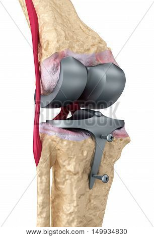 Knee and titanium hinge joint. Isolated on white