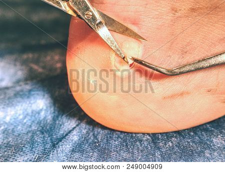 Nurse Help To Patient With Abrasion On The Skin On The Heel, Devastated Skin From Running Sports Sho