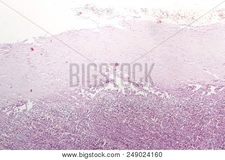 Splenic Capsule Hyaline Degeneration, Light Micrograph, Photo Under Microscope