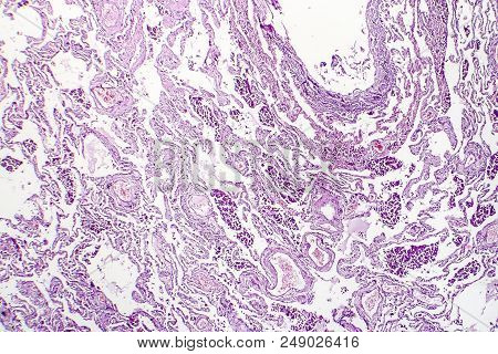 Chronic Pulmonary Congestion, Light Micrograph. Photo Under Microscope