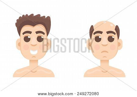 Hair Stages Loss. Types Of Baldness On Male Head Vector.