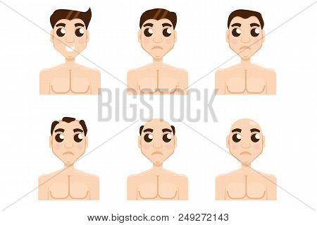 Hair Stages Loss. Types Of Baldness On Male Head Vector.
