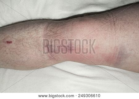 Damaged knee.Dislocation of the patella.Swollen knee.