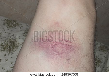 Damaged Swollen Knee Or Dislocation Of The Patella.