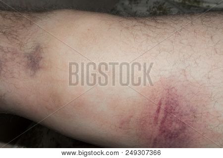 Damaged knee.Dislocation of the patella.Swollen knee.