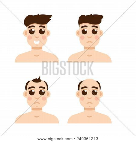 Hair Stages Loss. Types Of Baldness On Male Head Vector.