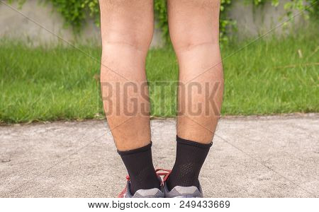 Asian Man Leg Bandy-legged Shape Of The Legs,selective Focus