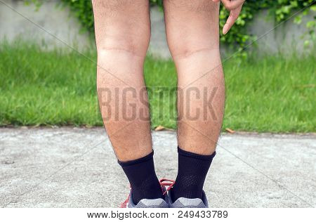 Asian Man Leg Bandy-legged Shape Of The Legs