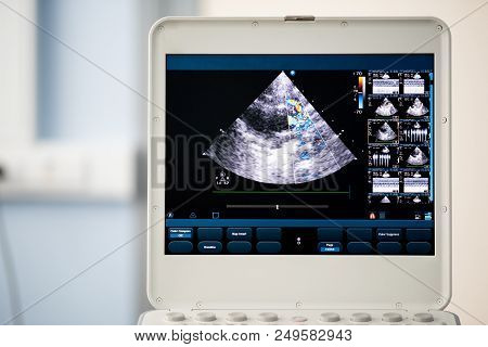 Screen Of An Ultrasound Device With A Heart Scan. Using The Doppler Method, The Right Ventricular Ou